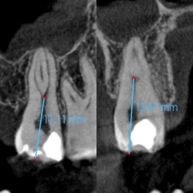 Before Endodontic Treatment Case 1 - Harp Endodontics Manhattan New York